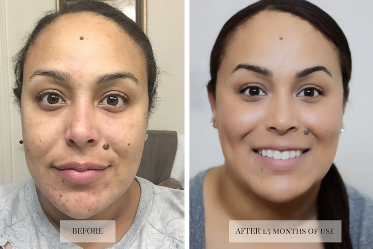 silkn-revit-microdermabrasion-beforeafter-makeup-life-and-love