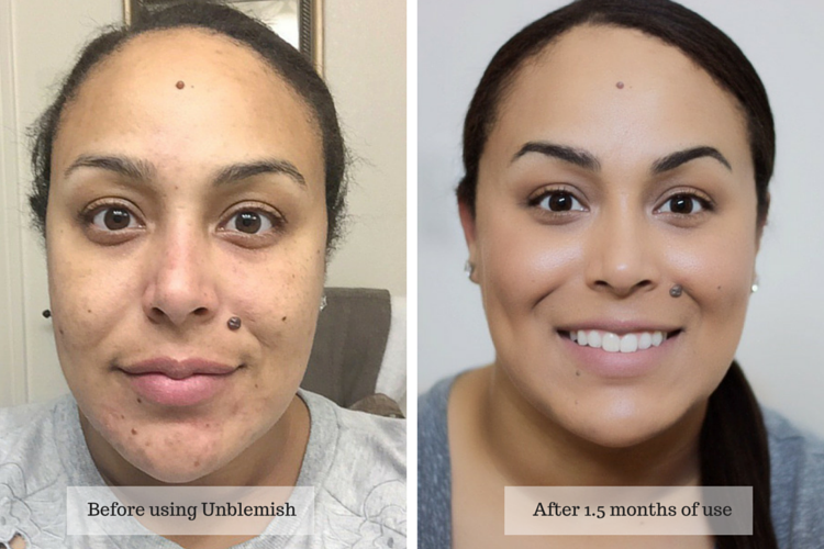 4 Easy Tips to Getting Clear Skin thanks to a bit of help from Rodan + Fields Unblemish skincare regimen- skincare- rodan fields- unblemish